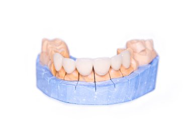 Beyaz arka planda izole edilmiş kaplama ve kaplamalar. Dişlerinin alçı modeli. Alt çene alçı modeli ve hazır dişler. Alçıdan çıkarılabilir model olarak çalışıyor. Teşhis modelinde beyaz ön diş kaplamaları