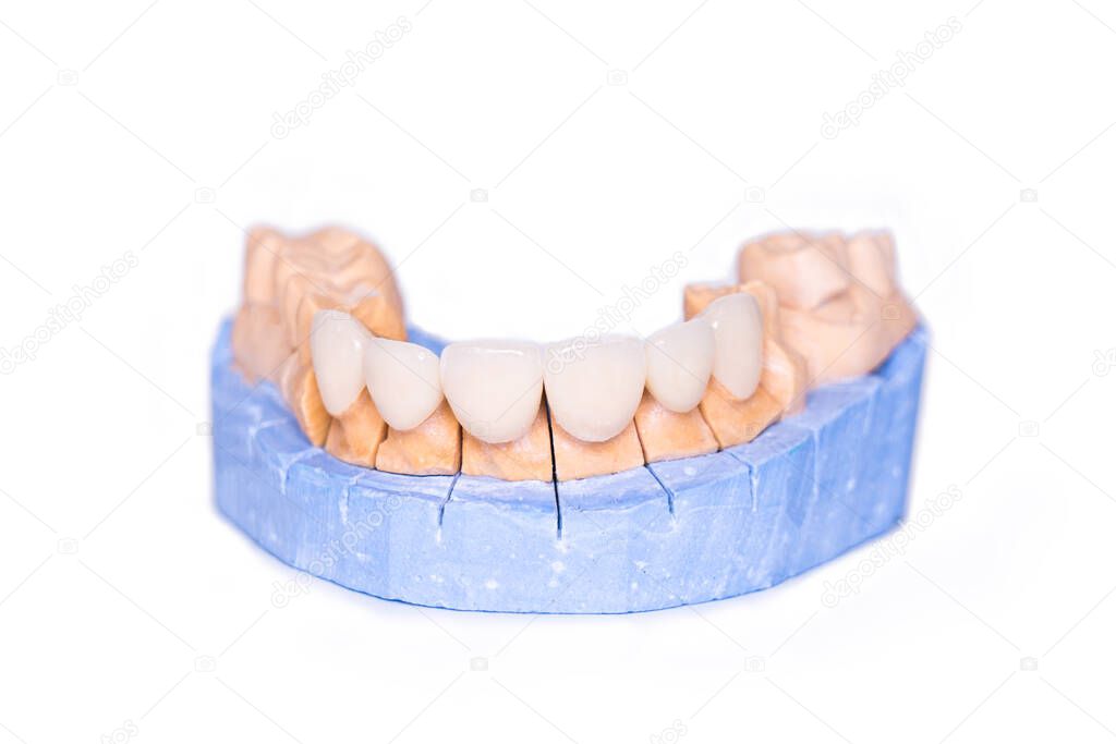 Veneers and crowns isolated on white background. Plaster model of teeth. lower jaw plaster model with prepared teeth. Working demountable plaster model. White front teeth veneers on diagnostic model