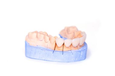 Beyaz arka planda izole edilmiş kaplama ve kaplamalar. Dişlerinin alçı modeli. Alt çene alçı modeli ve hazır dişler. Teşhis modelinde beyaz diş kaplamaları. Kozmetik dişçiliği kavramı