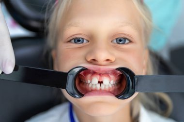Dişçi muayenehanesindeki küçük sarışın kız malocclusion ve diastema overbite aralığı olmayan dişler gösteriyor. Ortodontist muayenesi ve ağız boşluğu muayenesi sırasında çocuk. Çocuklara diş bakımı ve hijyen