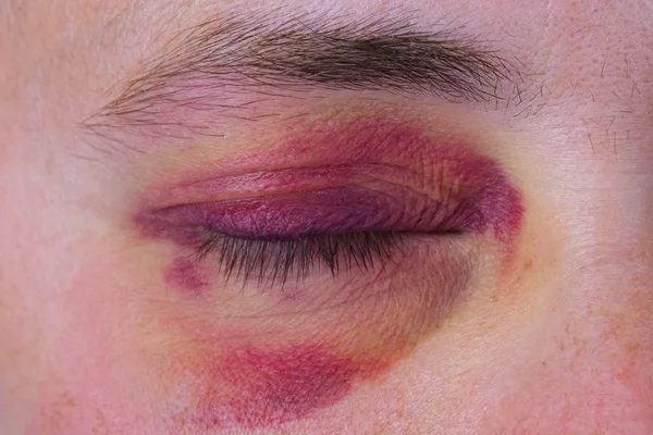 Olho humano com um hematoma roxo Fotografia De Stock