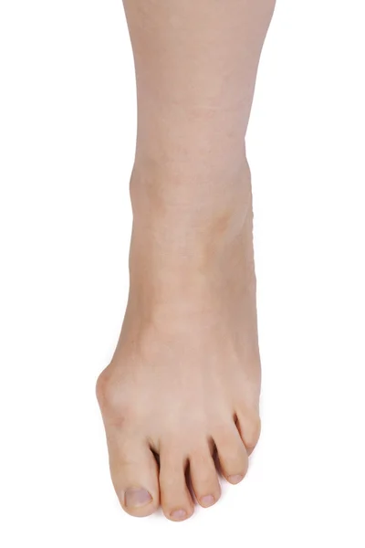 Нога с деформированным суставом — стоковое фото