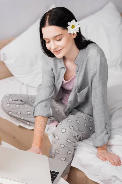 Freelancer Sonriente Con Vitiligo Flor Pelo Usando Ordenador Portátil Mesa — Foto de Stock