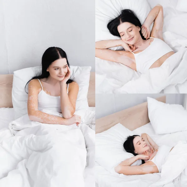 Kolase Wanita Ceria Dengan Vitiligo Berbaring Tempat Tidur — Stok Foto