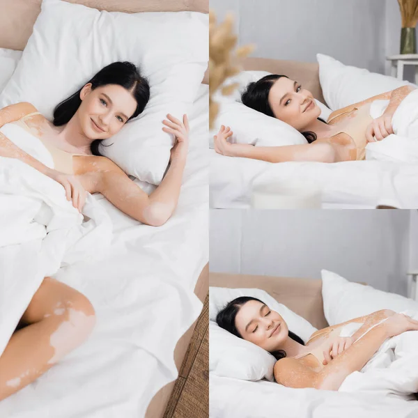 Collage Mujer Alegre Con Vitiligo Sonriendo Mientras Descansa Cama —  Fotos de Stock