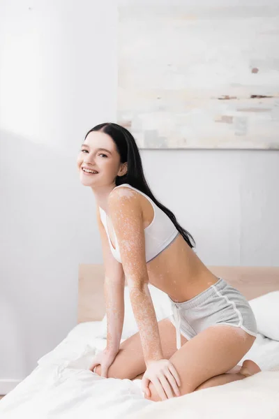 Glad Ung Kvinna Med Vitiligo Sitter Sängen — Stockfoto