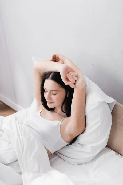 Brunette Young Woman Vitiligo Resting Bed — Stock Photo, Image