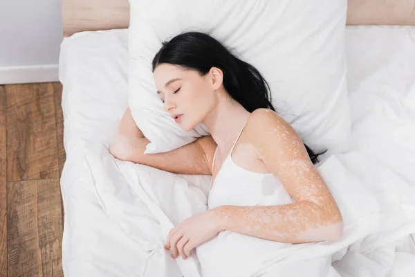 Vista Superior Mujer Joven Con Vitiligo Durmiendo Cama — Foto de Stock