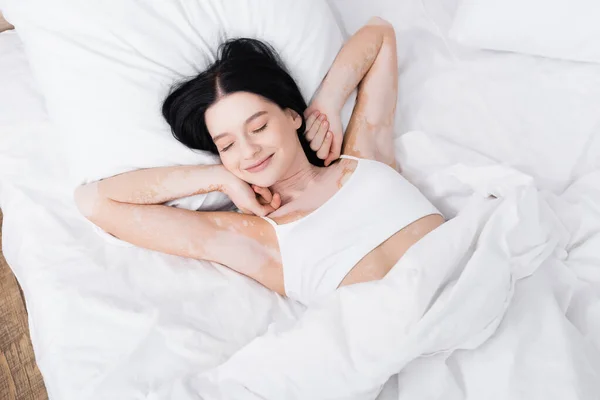 Högst Upp Bild Lat Ung Kvinna Med Vitiligo Liggande Sängen — Stockfoto