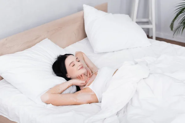 Lazy Young Woman Vitiligo Lying Stretching Bed — Stock Photo, Image