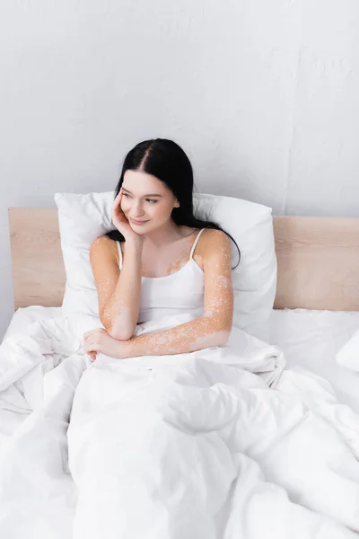 Mujer Joven Con Vitiligo Mirando Hacia Otro Lado Dormitorio — Foto de Stock