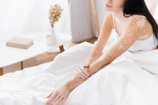 Gedeeltelijk Uitzicht Jonge Vrouw Met Vitiligo Slaapkamer — Stockfoto