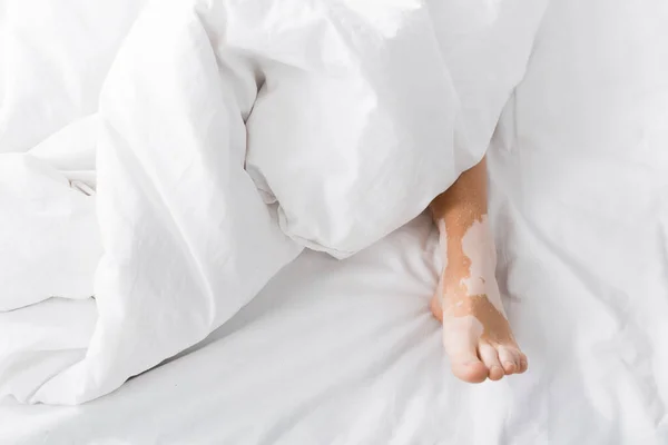 Vista Cortada Mulher Jovem Com Vitiligo Deitado Sob Cobertor — Fotografia de Stock