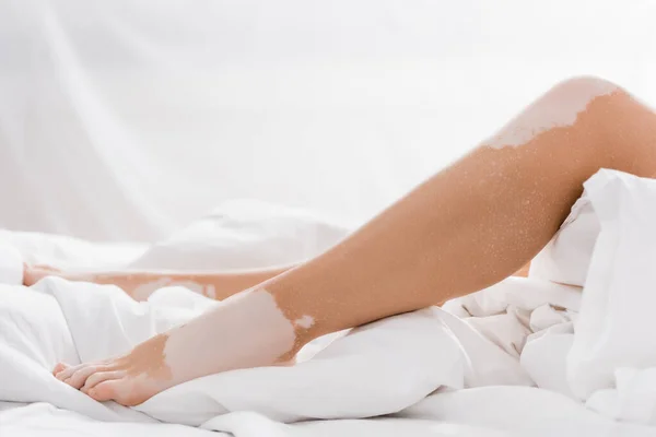 Обрізаний Вид Ноги Молодої Жінки Вітіліго Ліжку — стокове фото