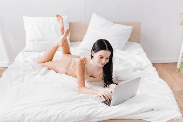 Happy Woman Vitiligo Lying Bed Typing Laptop — Stock Photo, Image