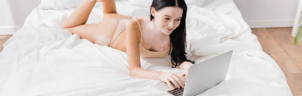 Happy Woman Vitiligo Lying Bed Using Laptop Banner — Stock Photo, Image