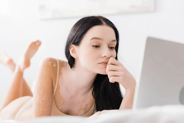 Brunett Kvinna Med Vitiligo Liggande Sängen Och Tittar Laptop — Stockfoto