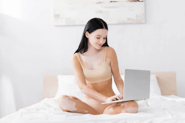 Lycklig Kvinna Med Vitiligo Sitter Sängen Och Använder Laptop — Stockfoto