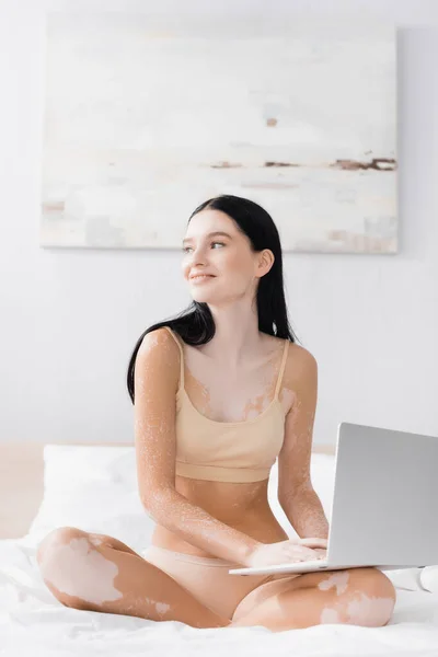 Leende Kvinna Med Vitiligo Sitter Sängen Med Laptop — Stockfoto