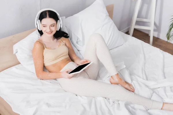 Mujer Feliz Con Vitiligo Auriculares Inalámbricos Sosteniendo Tableta Digital Con — Foto de Stock