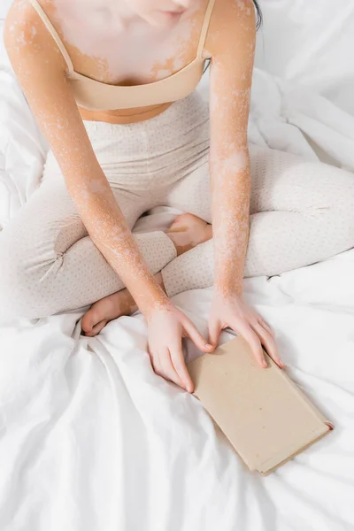 Bijgesneden Uitzicht Jonge Vrouw Met Vitiligo Holding Boek Slaapkamer — Stockfoto