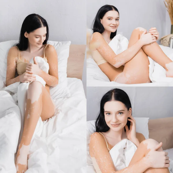 Collage di donna gioiosa con vitiligine sorridente mentre riposa a letto — Foto stock