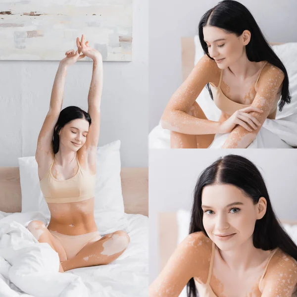 Collage de femme gaie avec vitiligo souriant tout en s'étirant au lit — Photo de stock