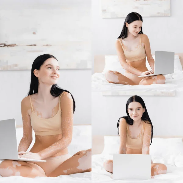 Collage de mujer sonriente con vitiligo usando portátil en la cama - foto de stock