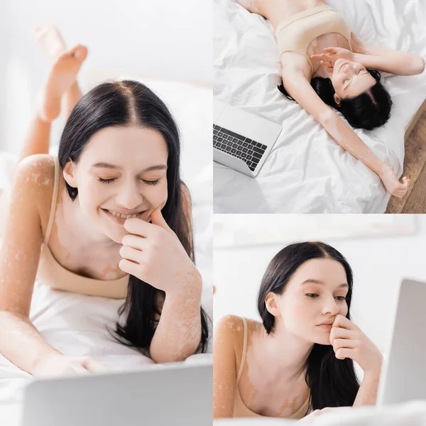 Collage de mujer morena con vitiligo acostado en la cama y utilizando el ordenador portátil - foto de stock