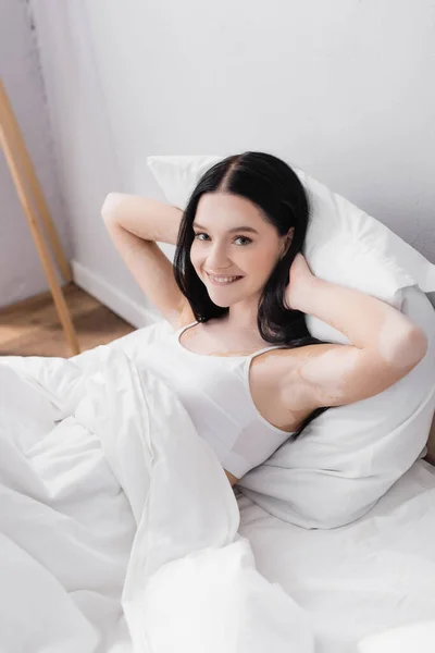 Donna sorridente con vitiligine a riposo a letto — Foto stock