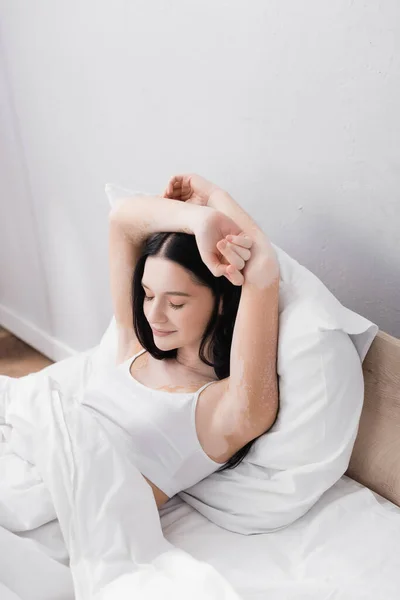 Brunette young woman with vitiligo resting in bed — Stock Photo