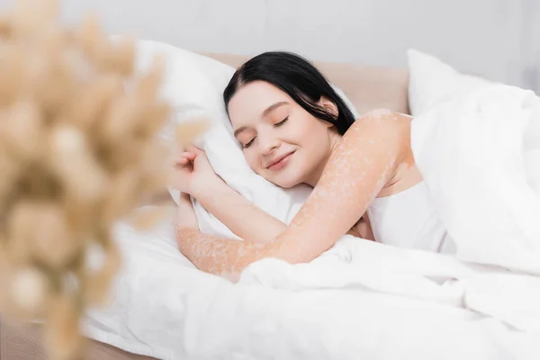 Lächelnde junge Frau mit Vitiligo liegt auf Kopfkissen im Bett mit verschwommenem Vordergrund — Stockfoto