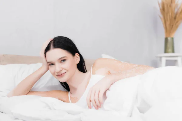 Sorridente giovane donna con vitiligine riposo e guardando la fotocamera in camera da letto — Foto stock