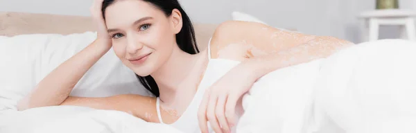 Smiling young woman with vitiligo resting and looking at camera in bedroom, banner — Stock Photo