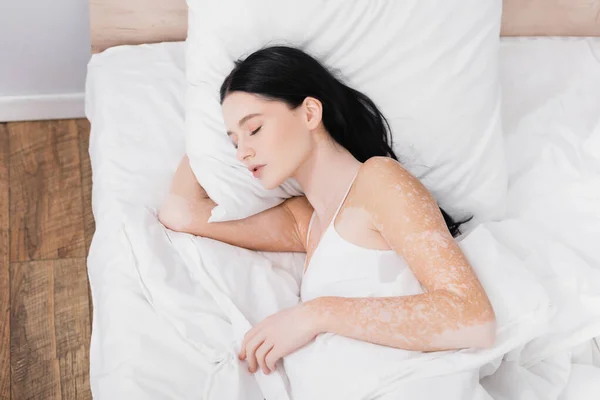 Top view of young woman with vitiligo sleeping in bed — Stock Photo