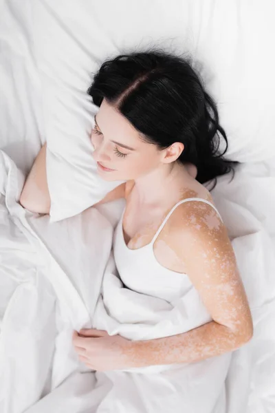 Vue de dessus de la jeune femme brune avec vitiligo dormir dans le lit — Photo de stock