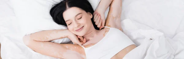 Top view of lazy young woman with vitiligo lying on bed, banner — Stock Photo