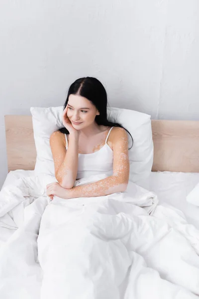 Young woman with vitiligo looking away in bedroom — Stock Photo