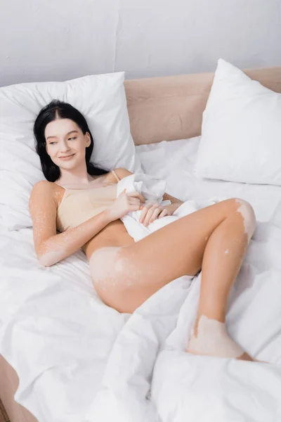 Joven mujer alegre con vitiligo acostado en la cama - foto de stock