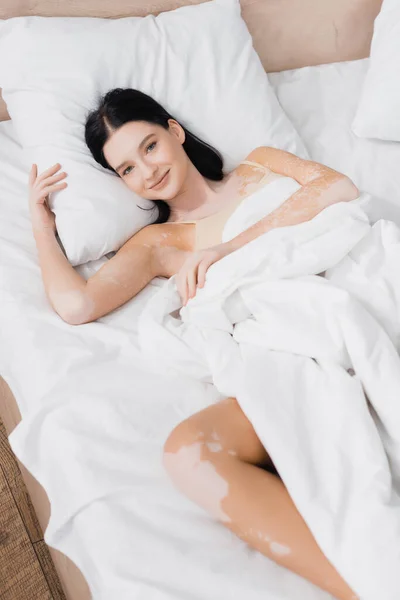Hochwinkel-Ansicht der jungen glücklichen Frau mit Vitiligo auf dem Bett liegend — Stockfoto