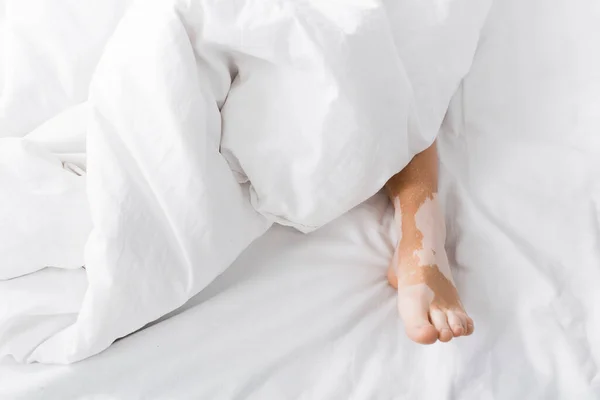 Cropped view of young woman with vitiligo lying under blanket — Stock Photo