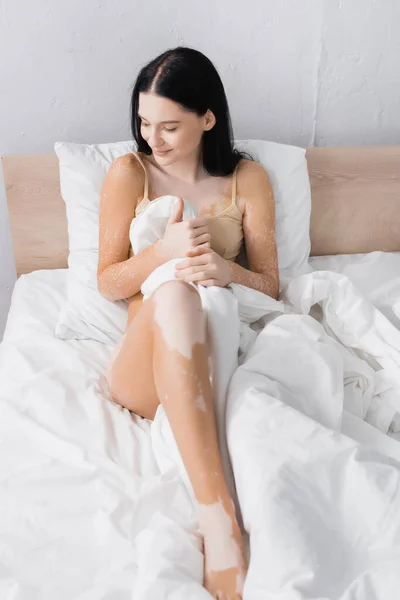 Giovane donna felice con vitiligine seduta sul letto — Foto stock