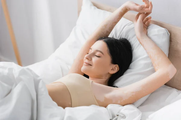 Young lazy woman with vitiligo and closed eyes lying on bed — Stock Photo