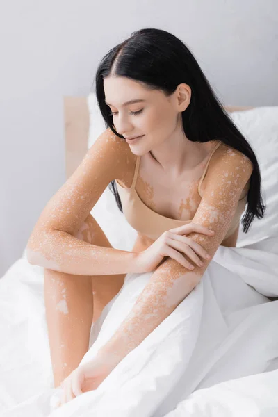 Jovem mulher preguiçosa com vitiligo e olhos fechados sentado na cama — Fotografia de Stock