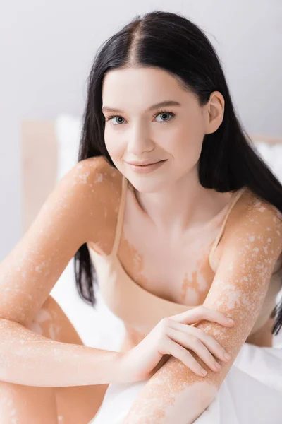 Junge und positive Frau mit Vitiligo vor der Kamera — Stockfoto