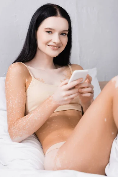 Young happy woman with vitiligo using smartphone in bedroom — Stock Photo