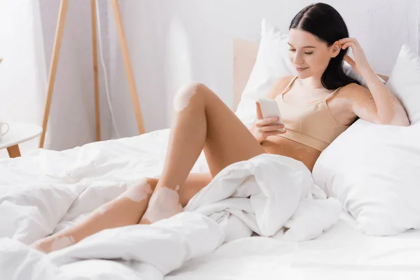 Allegra giovane donna con vitiligine utilizzando smartphone in camera da letto — Foto stock