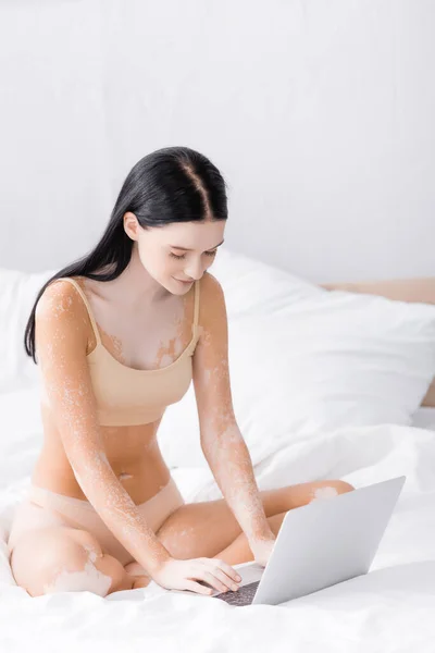 Morena freelancer con vitiligo usando laptop en el dormitorio - foto de stock