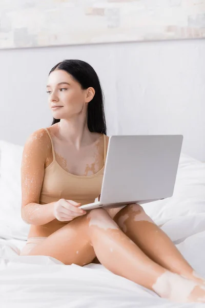 Morena freelancer con vitiligo celebración de ordenador portátil en el dormitorio - foto de stock