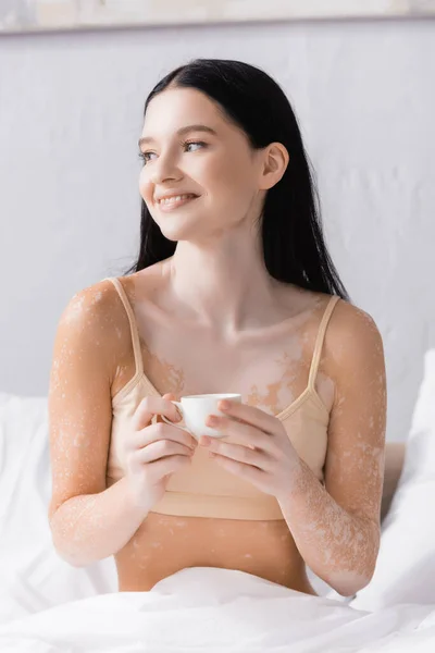 Mulher feliz com vitiligo segurando xícara de café — Fotografia de Stock